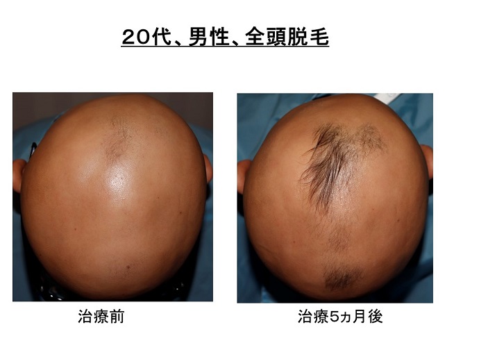 16年間治らなかった円形脱毛症が、治療5ヵ月で改善！ 患者様からの声・メディア掲載・クリニックからのお知らせ 名古屋Kクリニック